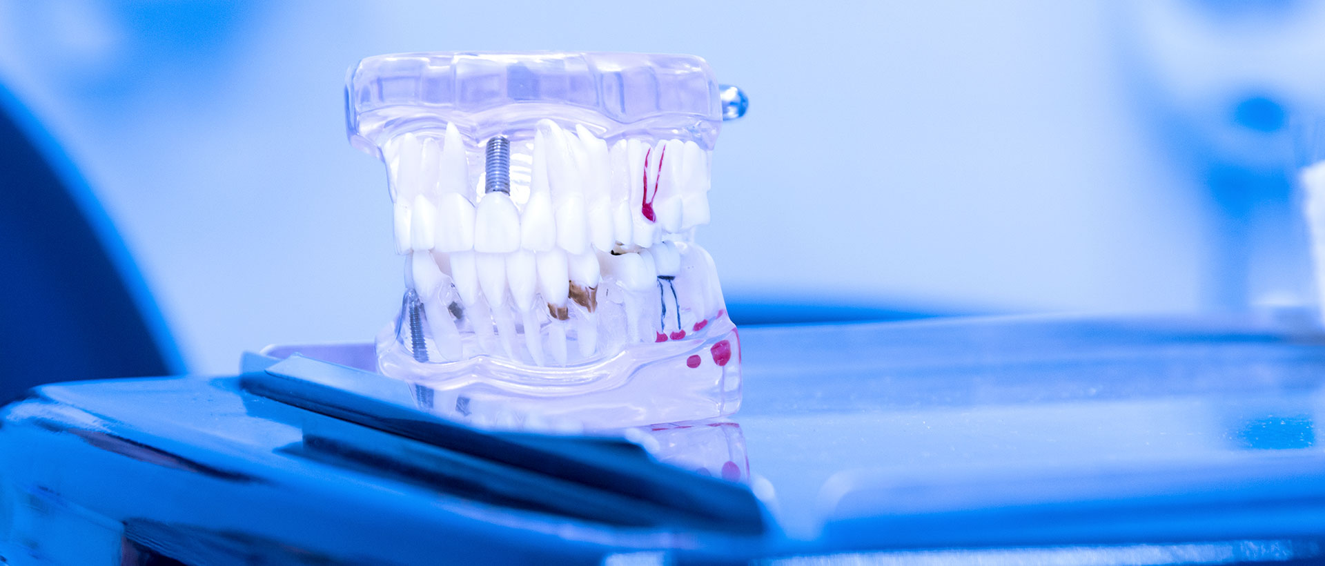 impianti dentali Verona