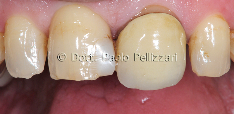 Estetica dentale VERONA caso 1 prima