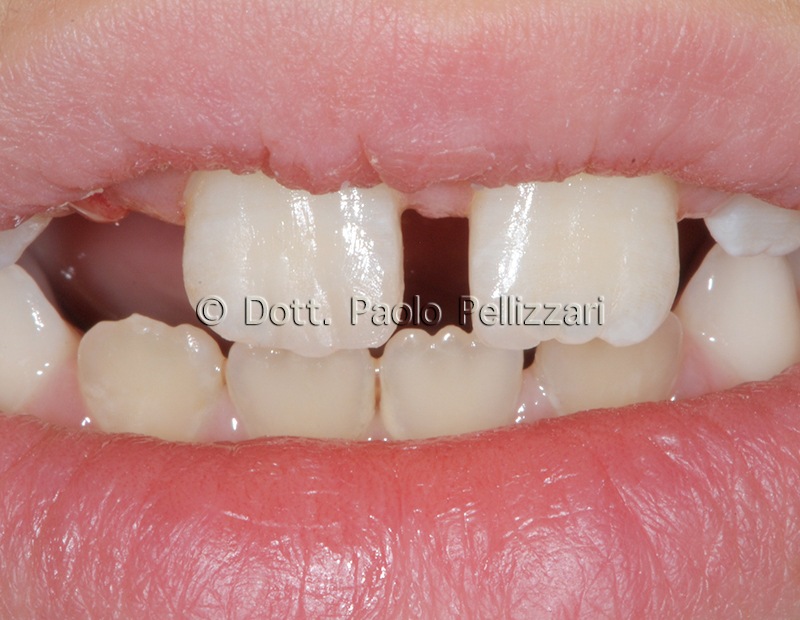 Conservativa Estetica dentale conservativa VERONA caso 2 dopo