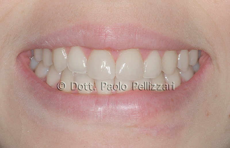 Estetica dentale VeronA caso 3 dopo