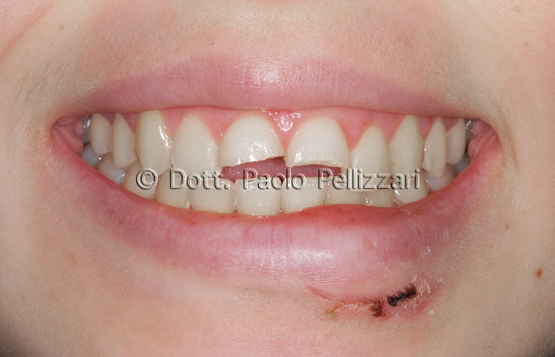 Estetica dentale VERONA caso 3 prima