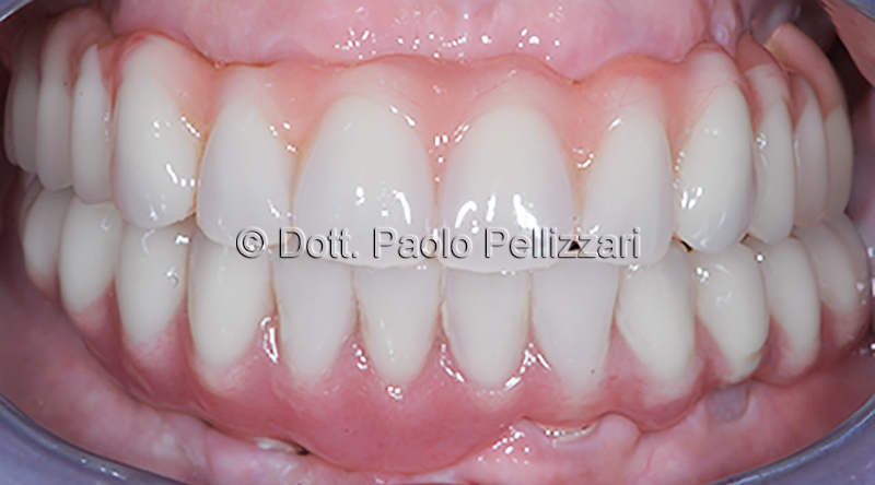 Implantologia VERONA caso 1 dopo