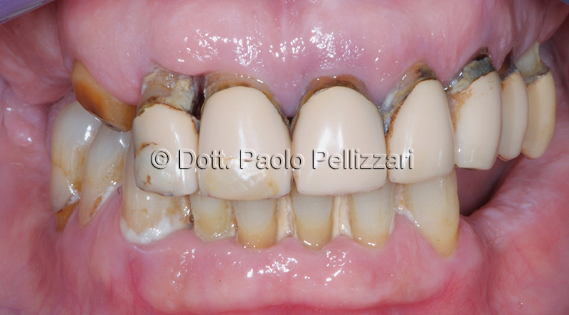 Implantologia VERONA caso 1 prima