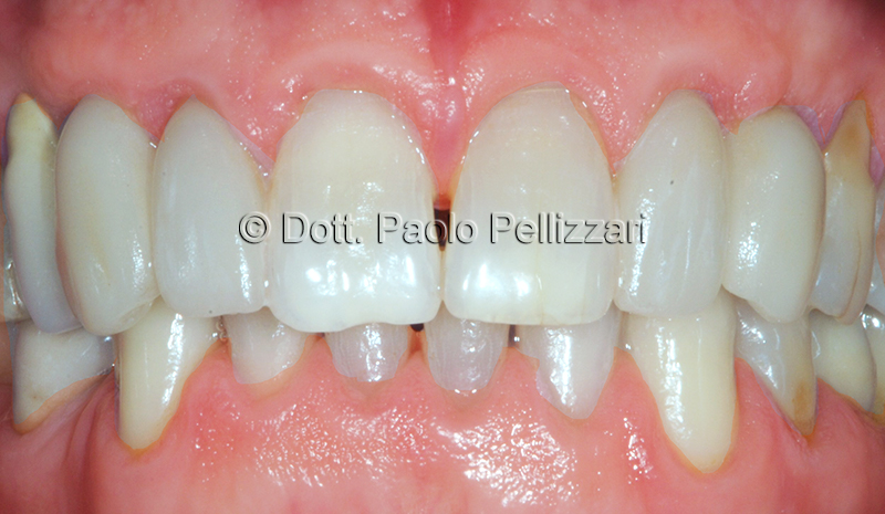 Implantologia VERONA caso 2 dopo