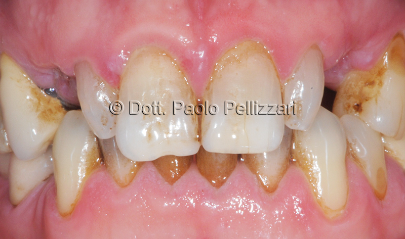 Implantologia VERONA caso 2 prima