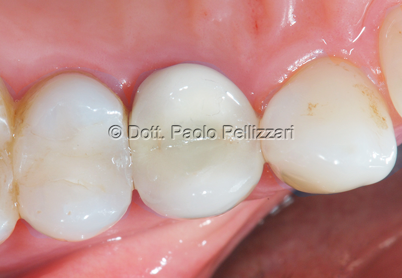 Implantologia VERONA caso 3 dopo
