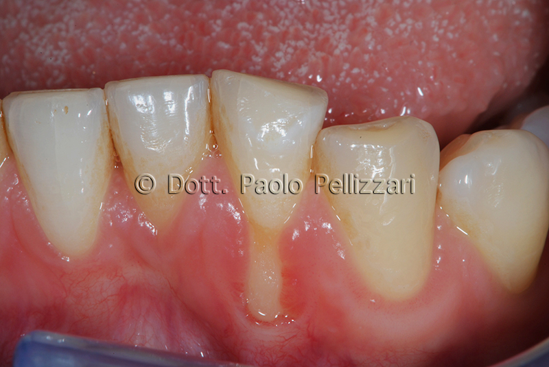 Intervento parodontologia VERONA caso 2 prima