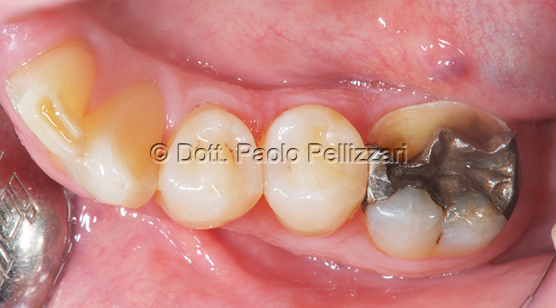 Conservativa Odontoiatria estetica VERONA caso 1 prima