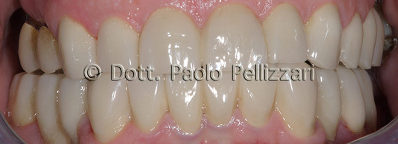 Riabilitazioni dentali totali VERONA caso 1 dopo 1