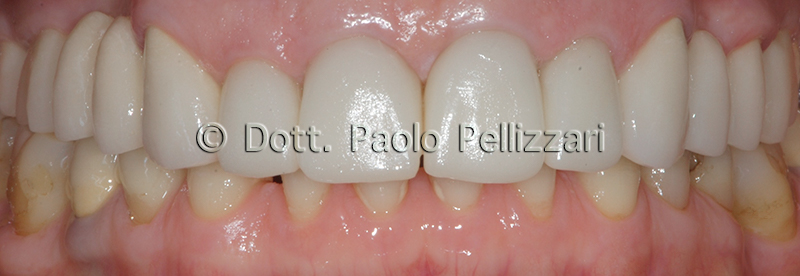 Riabilitazioni dentali totali VERONA caso 2 dopo