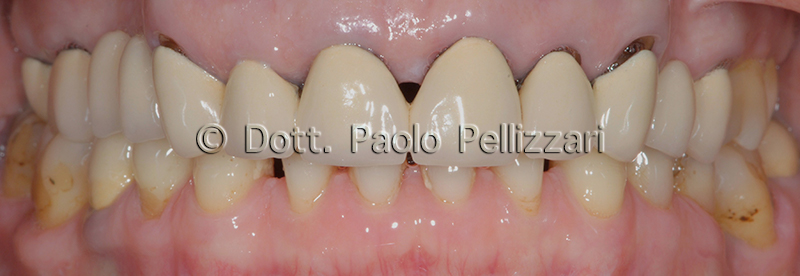 Riabilitazioni dentali totali VERONA caso 2 prima