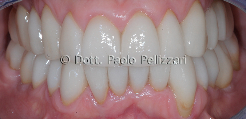 Riabilitazioni dentali totali VERONA caso 3 dopo