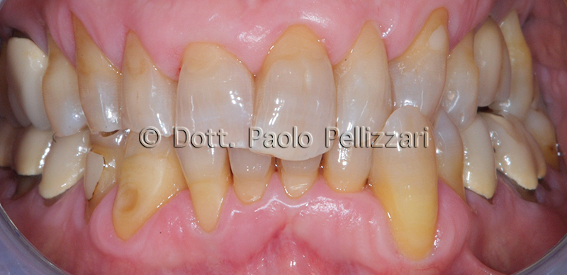 Riabilitazioni dentali totali VERONA caso 3 prima
