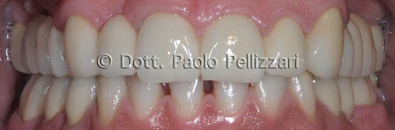 Riabilitazioni dentali totali VERONA caso 4 dopo