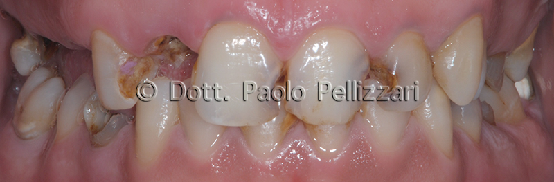 Riabilitazioni dentali totali VERONA caso 4 prima