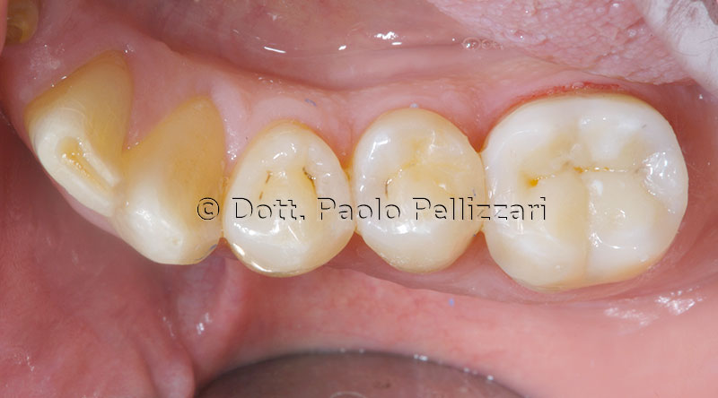 Conservativa odontoiatria Verona Caso 1 dopo